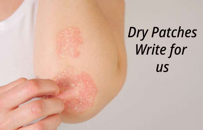 Dry Patches Write for us – Contribute and Submit Guest Post