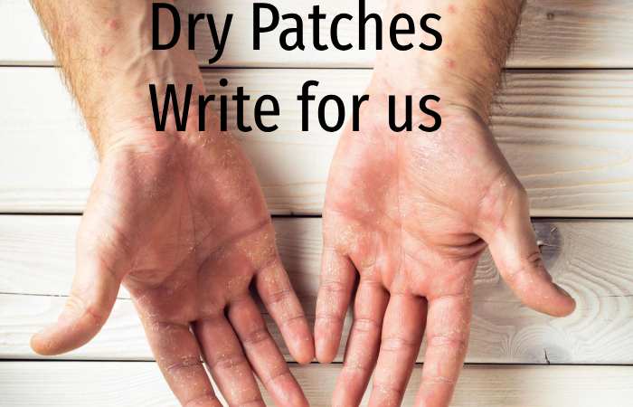 Dry Patches Write For us