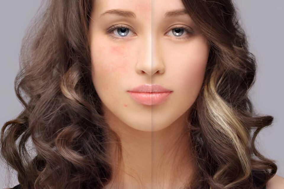 Exfoliators for Acne