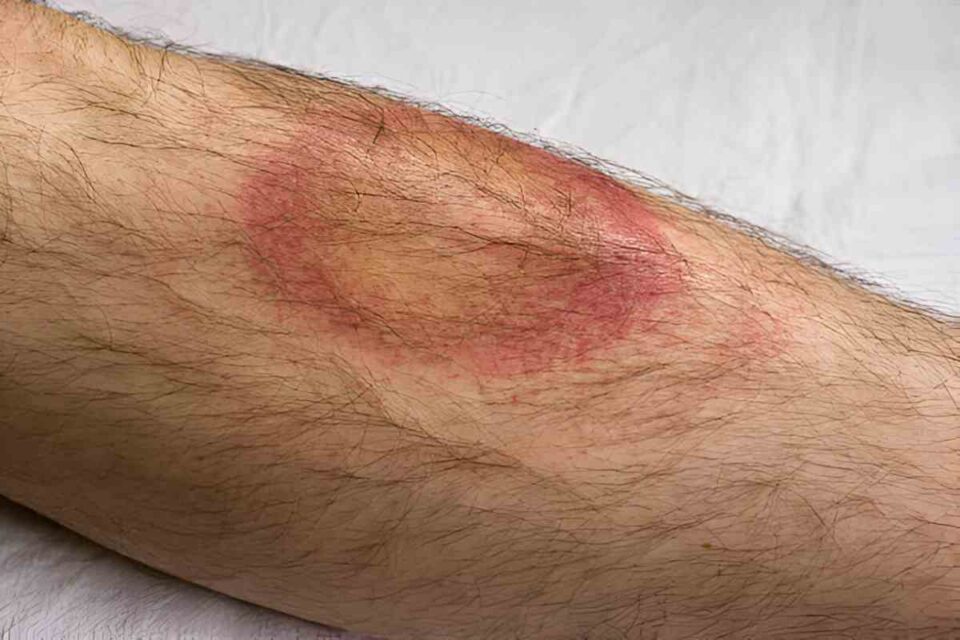 Lyme disease