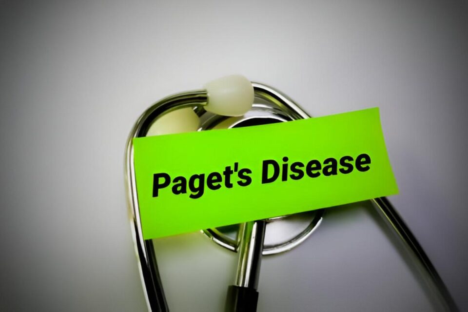 Pagets Disease Cause