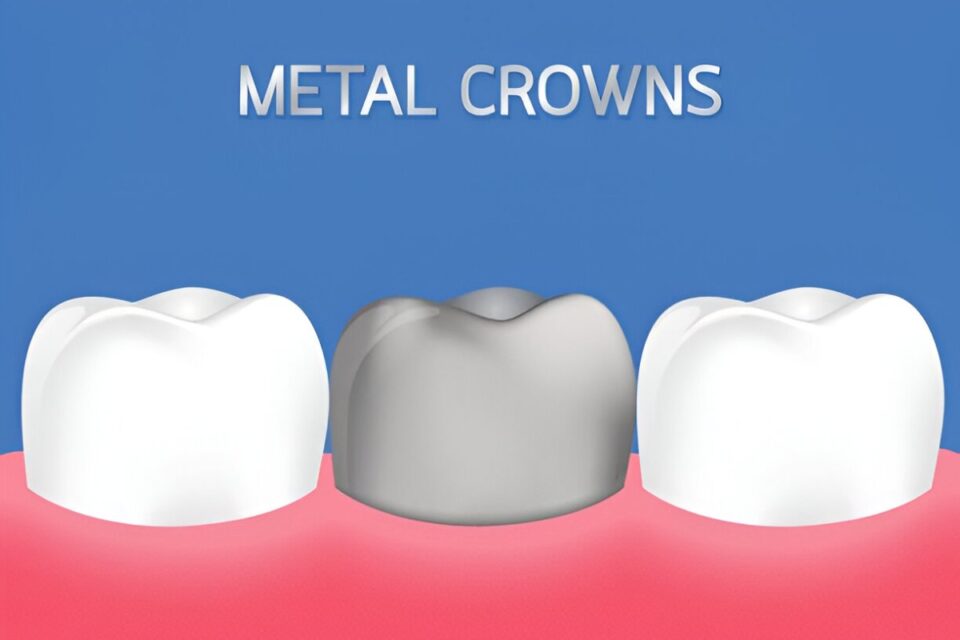 What Exactly Is a Metal Crown