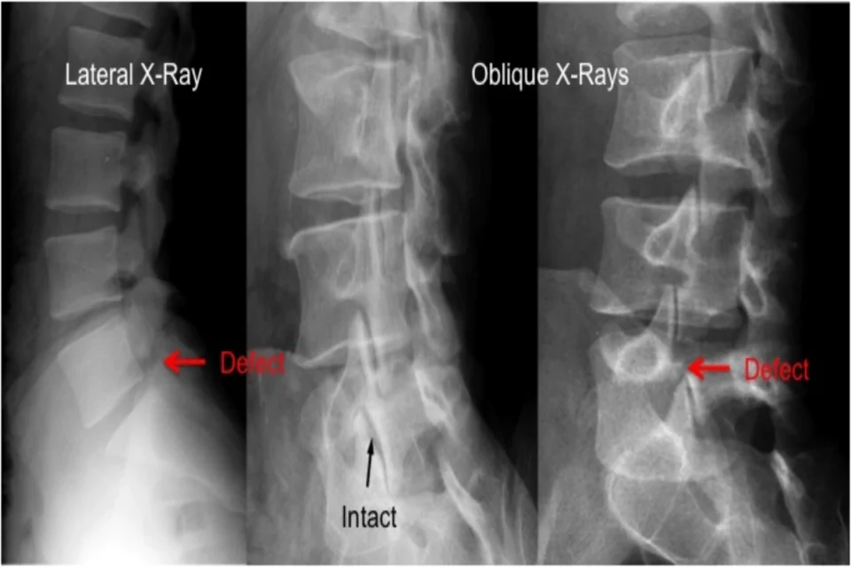 pars fracture